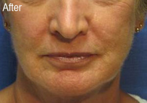 Woman After Radiesse | Before and After Photos | Dr. Lisa Bunin | Allentown PA