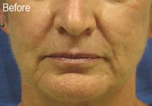 Woman Before Radiesse | Before and After Photos | Dr. Lisa Bunin | Allentown PA