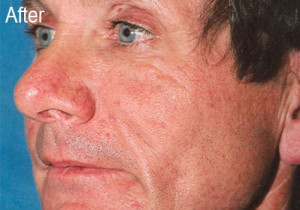 Man After Radiesse | Before and After Photos | Dr. Lisa Bunin | Allentown PA