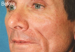 Man Before Radiesse | Before and After Photos | Dr. Lisa Bunin | Allentown PA