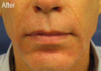 Male Radiesse Patient After | Before and After Photos | Dr. Lisa Bunin | Allentown PA