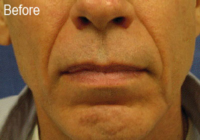 Male Radiesse Patient Before | Before and After Photos | Dr. Lisa Bunin | Allentown PA