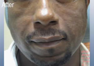 African American Male Radiesse Patient After | Before and After Photos | Dr. Lisa Bunin | Allentown PA