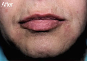 Male Radiesse Patient After | Before and After Photos | Dr. Lisa Bunin | Allentown PA