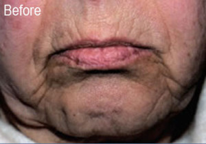 Male Radiesse Patient Before | Before and After Photos | Dr. Lisa Bunin | Allentown PA