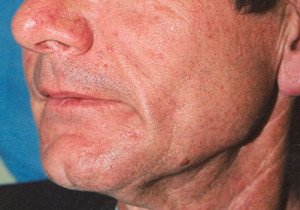 Male Radiesse Patient After | Before and After Photos | Dr. Lisa Bunin | Allentown PA