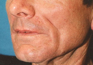 Male Radiesse Patient Before | Before and After Photos | Dr. Lisa Bunin | Allentown PA