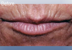 Restylane Lips Before 3 | Dr. Lisa Bunin | Before and After Photos | Allentown PA