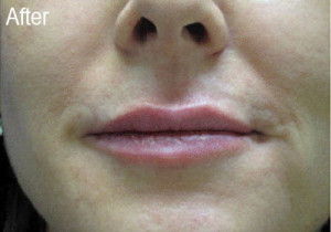 Restylane Female Patient 2 After | Before and After Photos | Dr. Lisa Bunin | Allentown PA