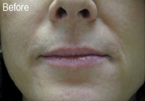 Restylane Female Patient 2 Before | Before and After Photos | Dr. Lisa Bunin | Allentown PA