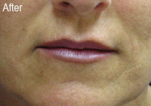 Restylane Female Patient 3 After | Before and After Photos | Dr. Lisa Bunin | Allentown PA