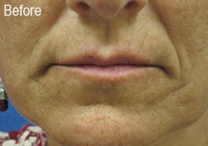 Restylane Female Patient 3 Before | Before and After Photos | Dr. Lisa Bunin | Allentown PA
