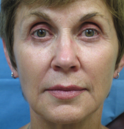 Sculptra Patient 1 After | Front View | Before and After Photos |Dr. Lisa Bunin | Allentown PA