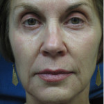 Sculptra Patient 1 Before | Front View | Before and After Photos |Dr. Lisa Bunin | Allentown PA