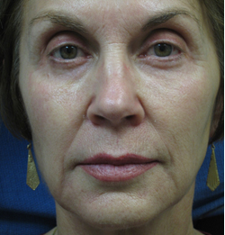 Sculptra Patient 1 Before | Front View | Before and After Photos |Dr. Lisa Bunin | Allentown PA