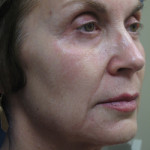 Sculptra Patient 1 Before | Side View | Before and After Photos | Dr. Lisa Bunin | Allentown PA