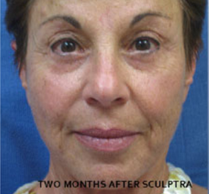 Sculptra Patient 2 Before | Front View | Before and After Photos |Dr. Lisa Bunin | Allentown PA