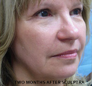 Sculptra Patient 3 After | Side View | Before and After Photos |Dr. Lisa Bunin | Allentown PA
