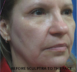 Sculptra Patient 3 Before | Side View | Before and After Photos |Dr. Lisa Bunin | Allentown PA
