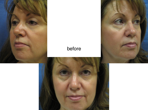 Voluma R-Lift Patient 2 | Dr. Lisa Bunin | Before and After Photos | Allentown PA