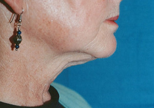 Titan Skin Tightening Patient After | Before and After Photos | Dr. Lisa Bunin | Allentown PA