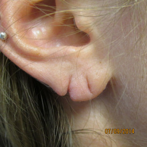 torn earlobe before reapir, Allentown, PA