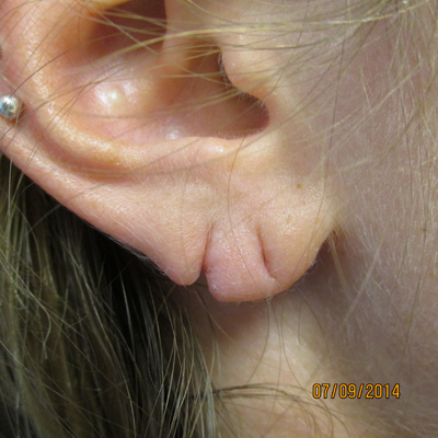 Lisa Bunin Md Torn Earlobe Repair Allentown Pa