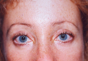 Eyelift Patient After | Upper Eyelid | Blepharoplasty | Before and After Photos | Dr. Lisa Bunin | Allentown PA