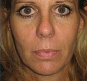 Voluma R Patient 1 Before | Front View | Radiesse | Before and After Photos |Dr. Lisa Bunin | Allentown PA