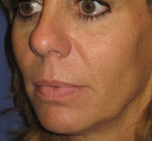 Voluma R Patient 1 Before | Side View | Radiesse | Before and After Photos |Dr. Lisa Bunin | Allentown PA