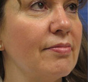 Voluma R Patient 2 After | Side View | Radiesse | Before and After Photos |Dr. Lisa Bunin | Allentown PA