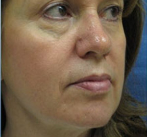 Voluma R Patient 2 Before | Side View | Radiesse | Before and After Photos |Dr. Lisa Bunin | Allentown PA