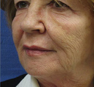 Voluma R Patient 3 After | Side View | Radiesse | Before and After Photos |Dr. Lisa Bunin | Allentown PA