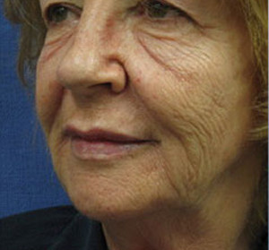 Voluma R Patient 3 Before | Side View| Radiesse | Before and After Photos |Dr. Lisa Bunin | Allentown PA