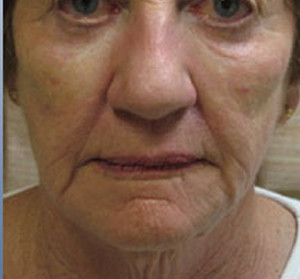 Voluma R Patient 4 After | Front View | Radiesse | Before and After Photos |Dr. Lisa Bunin | Allentown PA