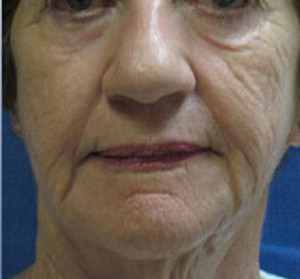 Voluma R Patient 14Before | Front View | Radiesse | Before and After Photos |Dr. Lisa Bunin | Allentown PA