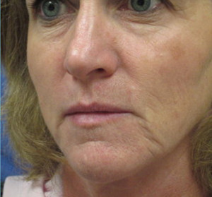 Voluma R Patient 5 After | Side View | Radiesse | Before and After Photos |Dr. Lisa Bunin | Allentown PA