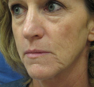 Voluma R Patient 5 Before | Side View | Radiesse | Before and After Photos |Dr. Lisa Bunin | Allentown PA