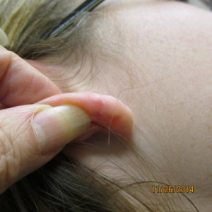 after repair of torn earlobe, Allentonw, PA