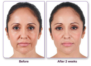 Juvederm Ultra Plus XC Before and After 1 | Dr. Lisa Bunin | Allentown PA