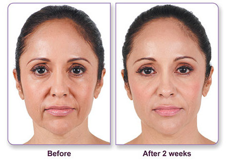 Facial before and after photos For that Facial before and after photos opinion you