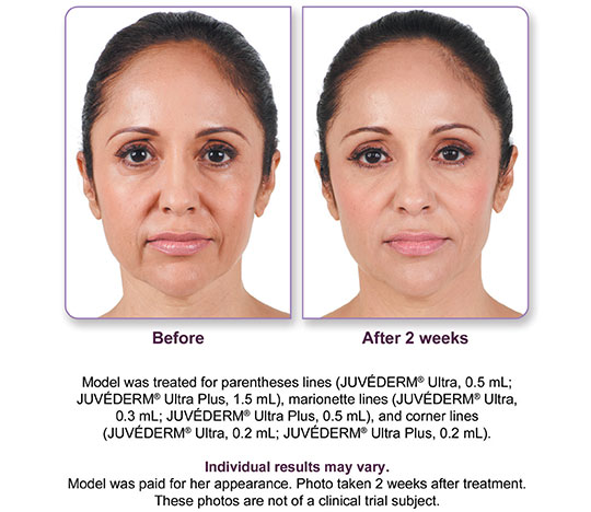 Juvederm Ultra Plus XC Before and After 1 | Dr. Lisa Bunin | Allentown PA