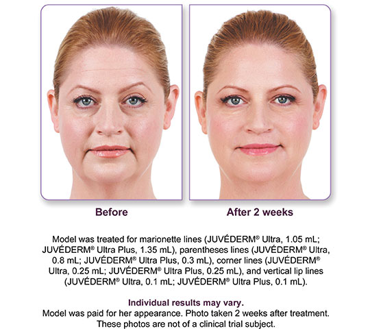 Juvederm Ultra Plus XC Before and After 3 | Dr. Lisa Bunin | Allentown PA