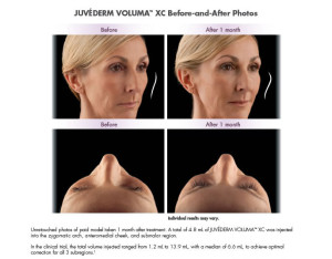 Juvederm Voluma XC Before and After Photos | Dr. Lisa Bunin | Allentown PA