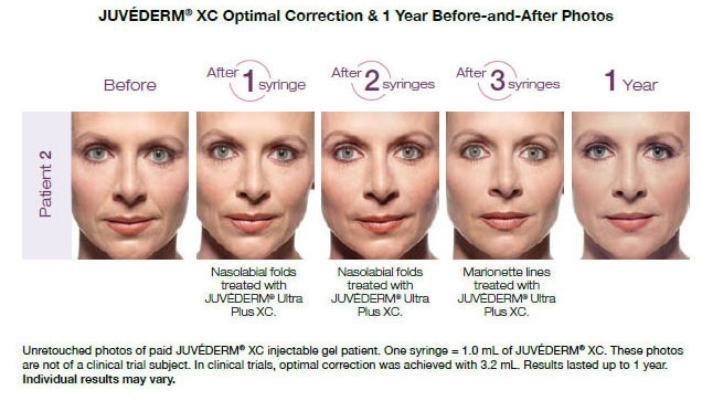 Juvedern XC Before and After Photos | Dr. Lisa Bunin | Allentown PA