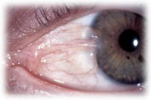 Pterygium | Eye | Dr. Lisa Bunin | Allentown PA