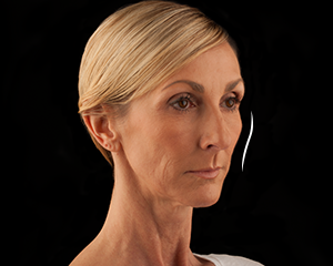 Voluma Patient 2 Before | Dr. Lisa Bunin | Allentown PA