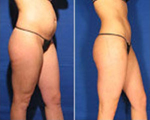 Zerona Before and After Side | Dr. Lisa Bunin | Allentown PA