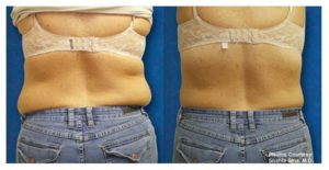 Zerona Before and After Back | Dr. Lisa Bunin | Allentown PA