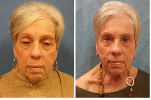 Ptosis-Blepharoplasty 2